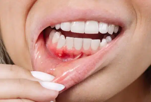 Cirugía estética periodontal en Santiago Chile