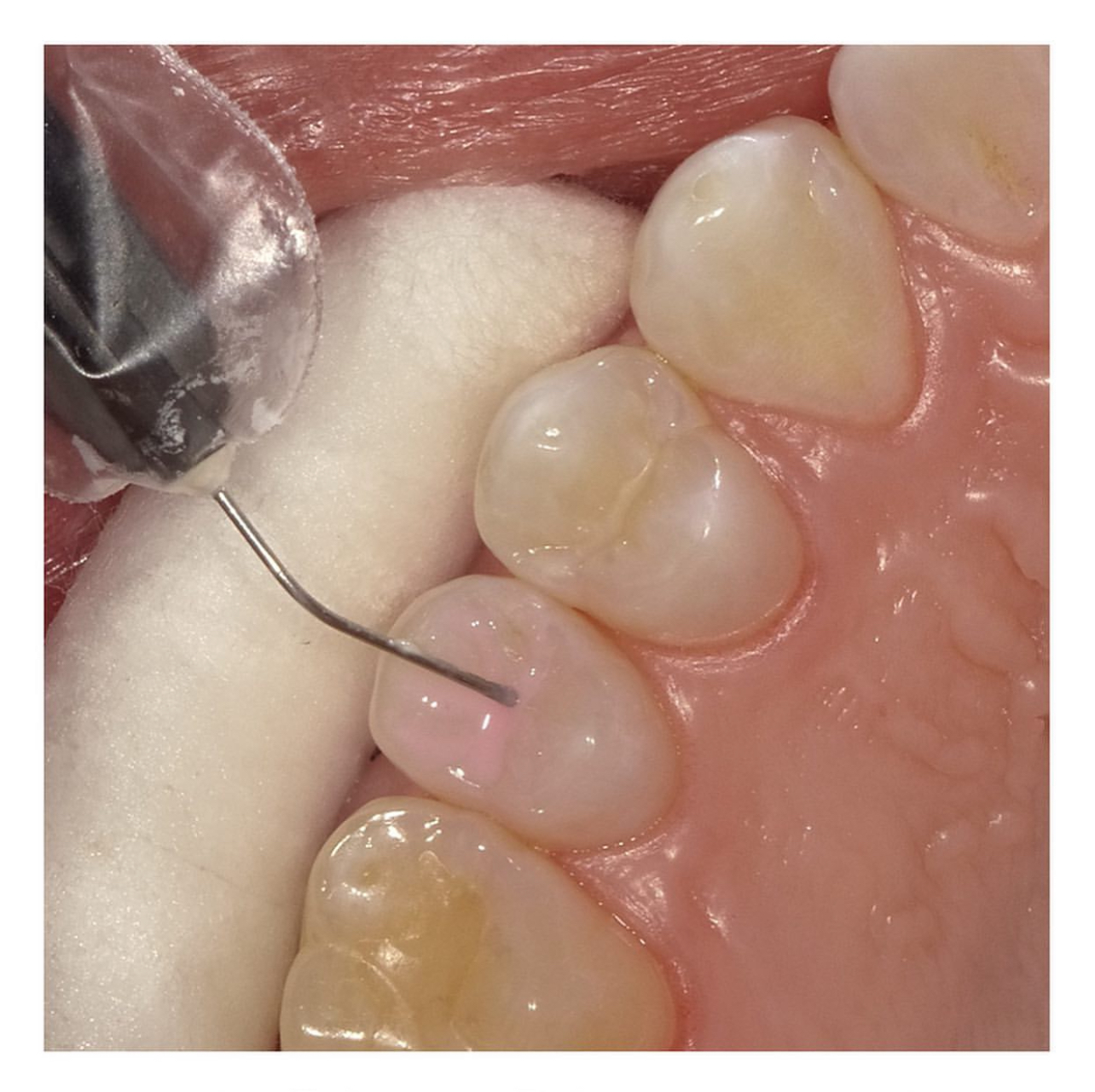 Sellantes dentales