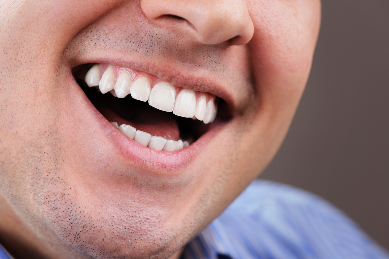 Blanqueamiento dental profesional